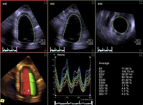 Intervendor Consistency and Accuracy of Left Ventricular Volume 